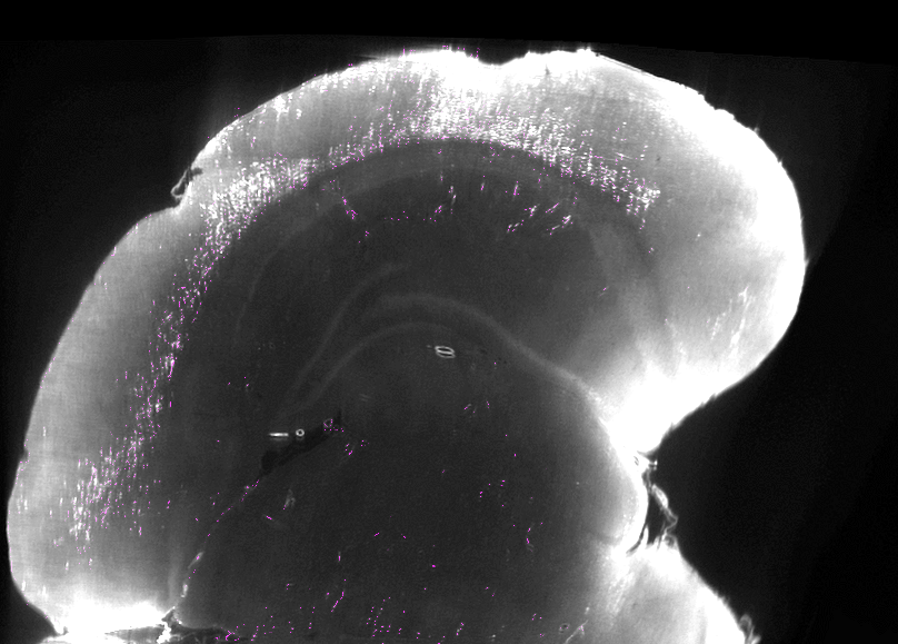 Temporal association area slice from the same brain.
